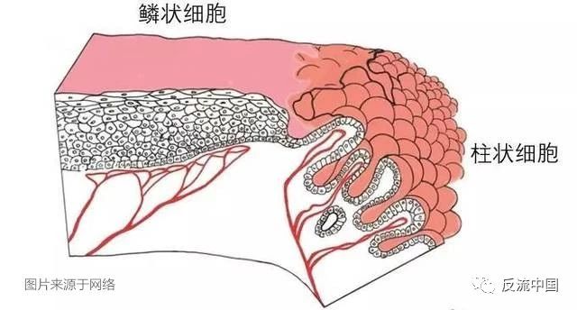 雖然發病率大約只佔10%左右,但因近年來的研究發現它與食管癌的發生